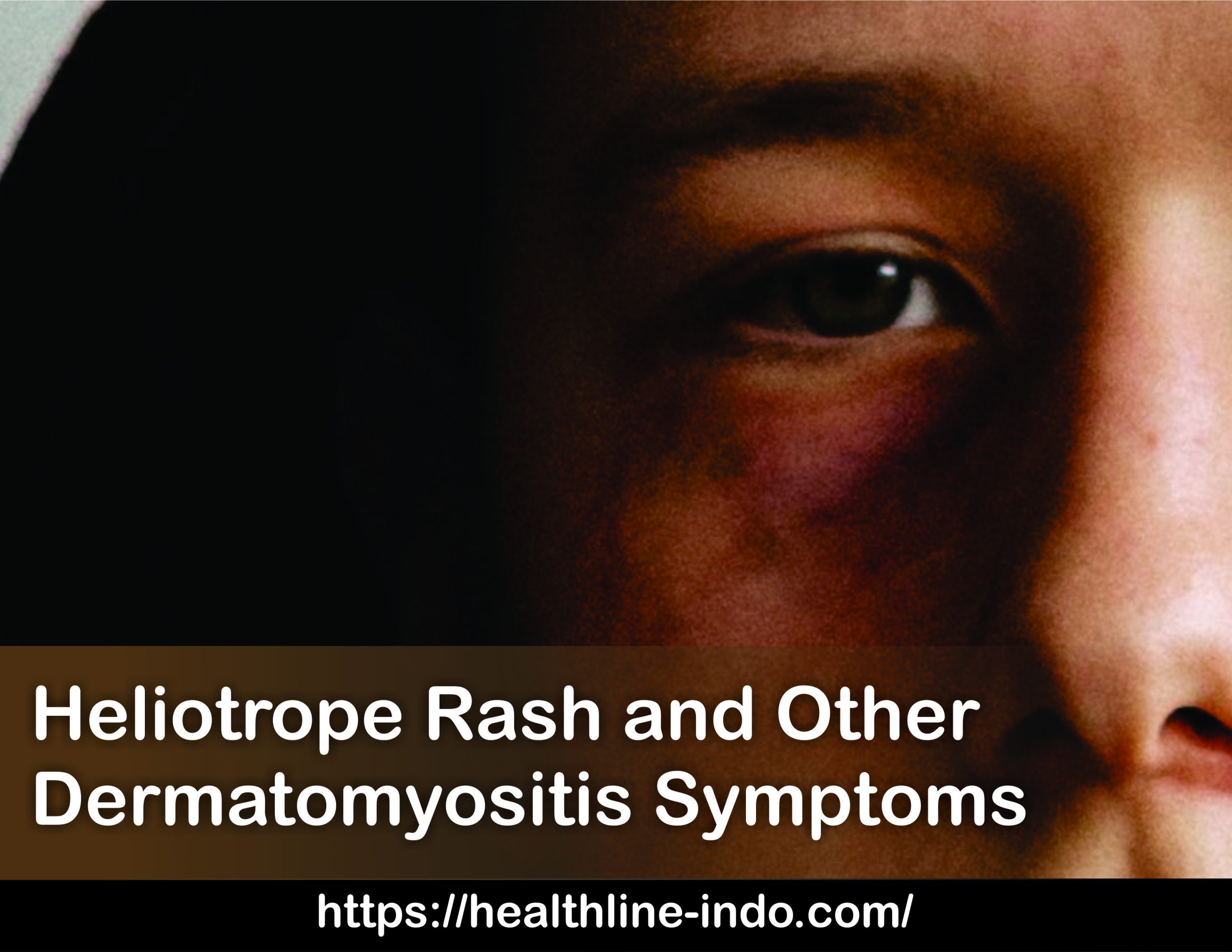 Haliotrop Rash Heliotrope Rash Symptoms | Dermatomyositis: Causes, Symptoms, and ...